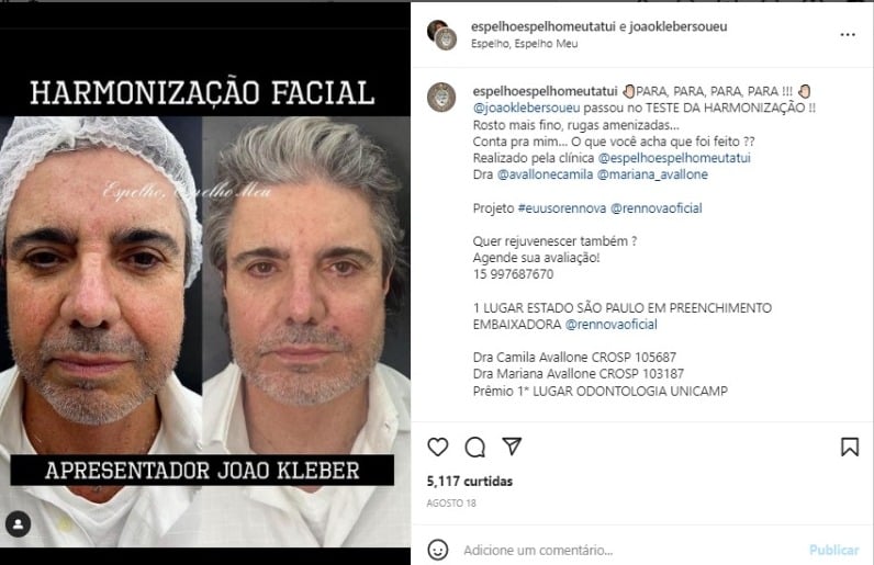 João Kleber se rendeu à harmonização facial e mostra antes e depois (Foto: Reprodução/Instagram)