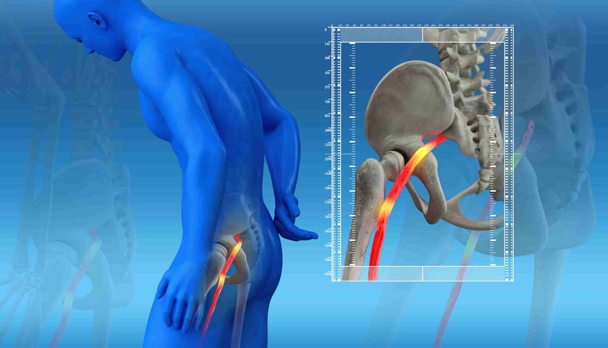 Localização do nervo ciático no corpo humano (Foto: Reprodução/ Internet/ Imagem Ilustrativa)